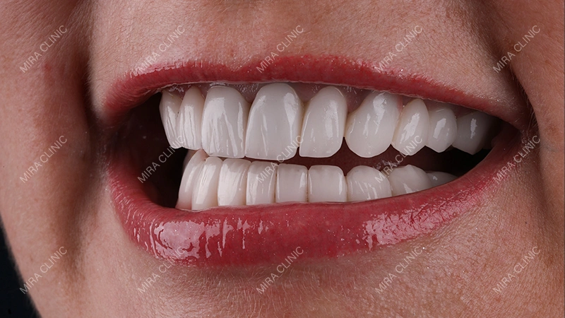 real example of implants and crowns